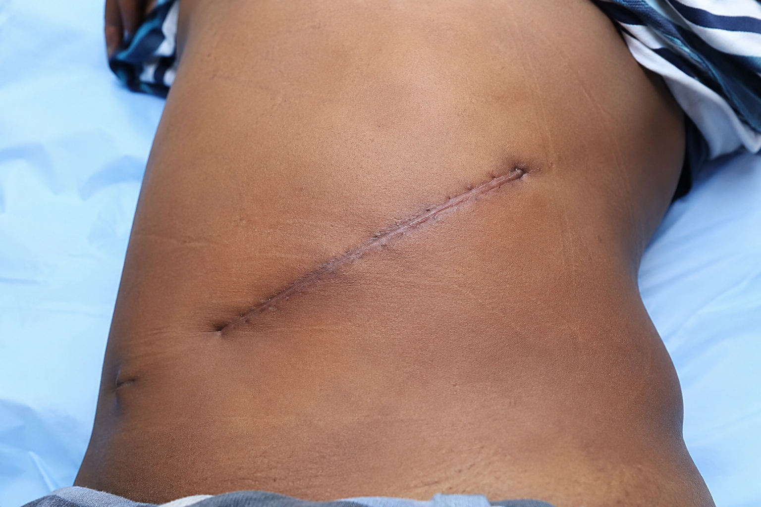 Abuja Kidney Case Raises Serious Questions About Patient Consent and Safety